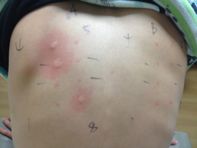 Image result for honey allergy symptoms